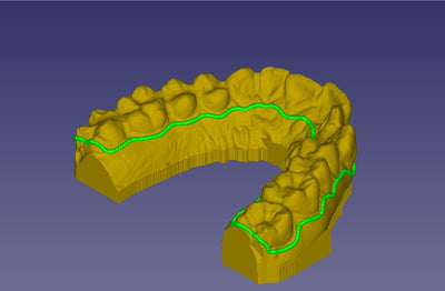 How to find affordable orthodontic treatment?