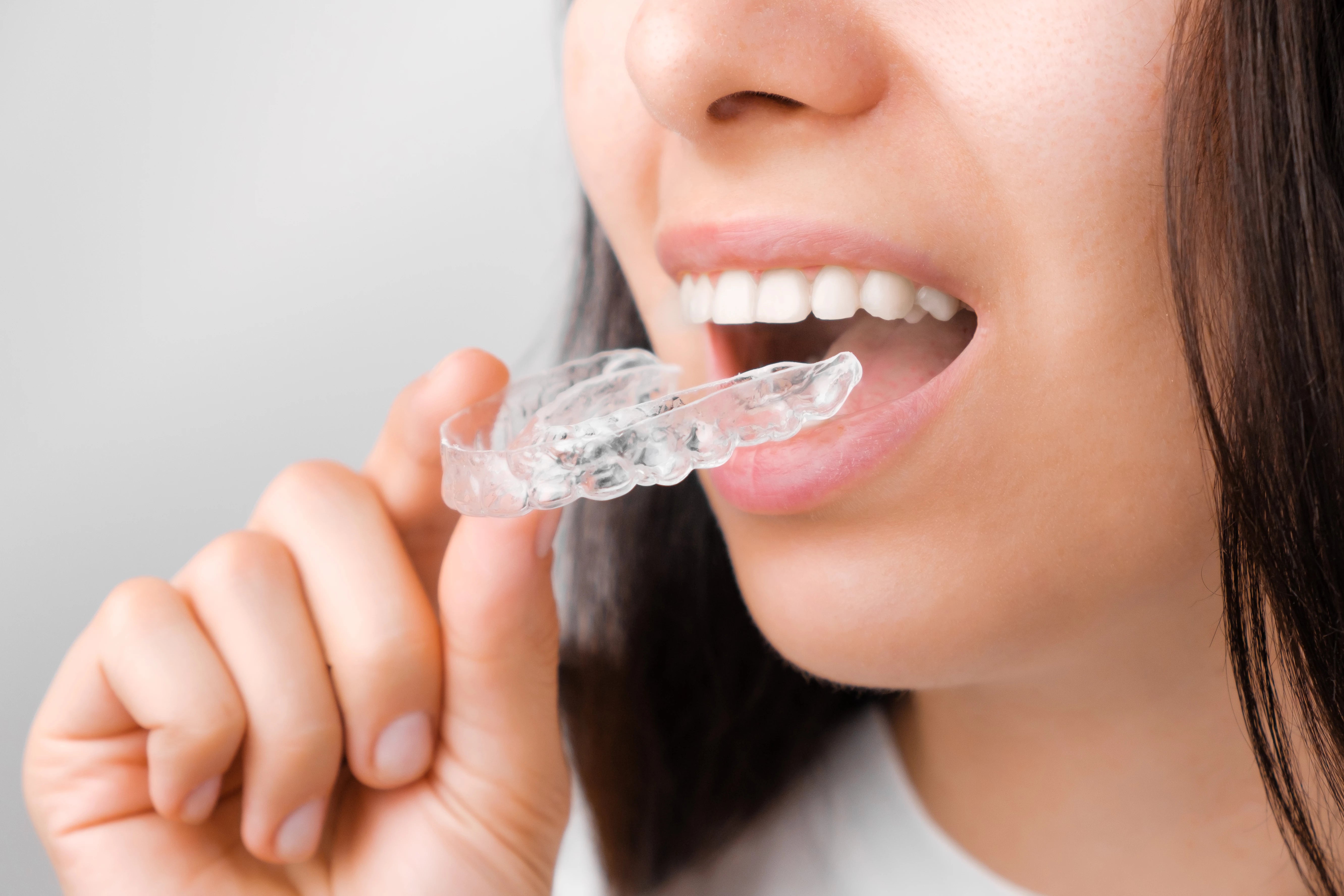 Clear Aligner
