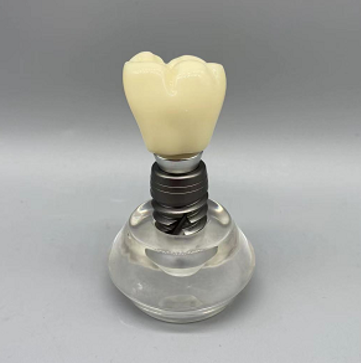 Dental Implant Educational Model (Copy)