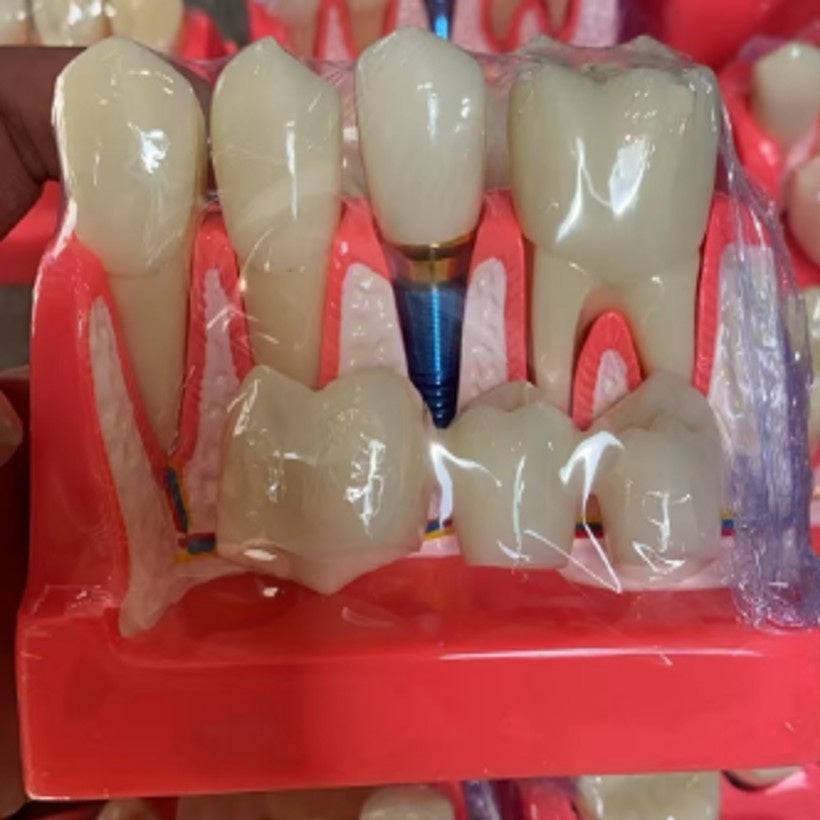 Veneer Dental Implant Model