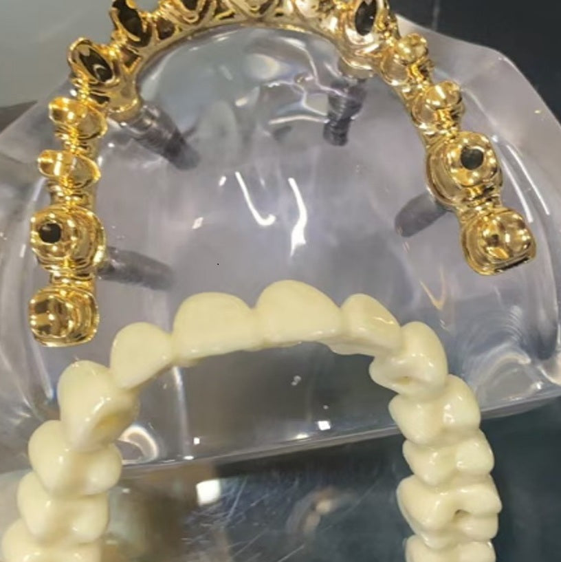 Aesthetic Bridge 4 Implant