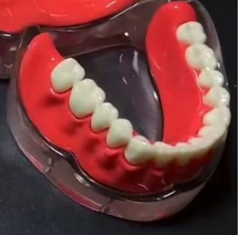 Implant Model Full Mouth Denture Mandible or Maxilla