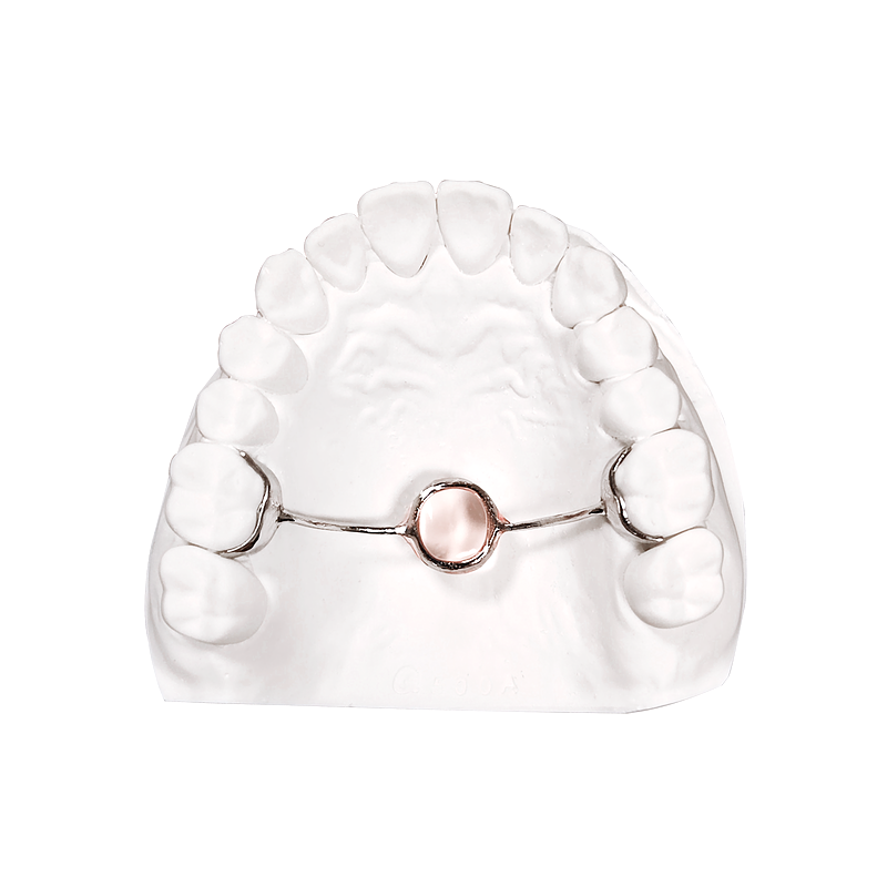 3D-Printed Transpalatal Arch custom orthodontic appliance