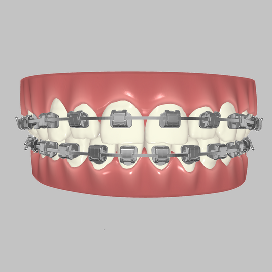 Custom Braces - We made orthodontic treatment easy!