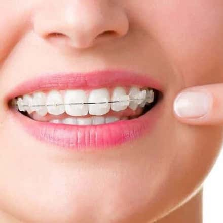 Custom Braces - We made orthodontic treatment easy!
