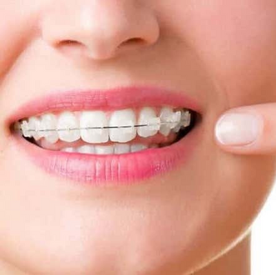 Customized Braces - UPLOAD YOUR INTRA-ORAL SCANNED FILE