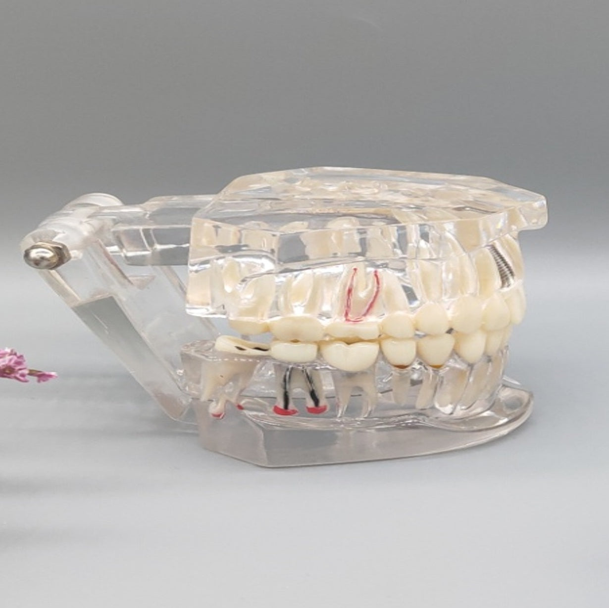 Transparent pathological tooth model