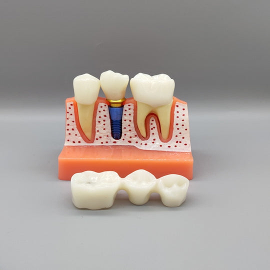 Dental Implant Educational Model (Copy)