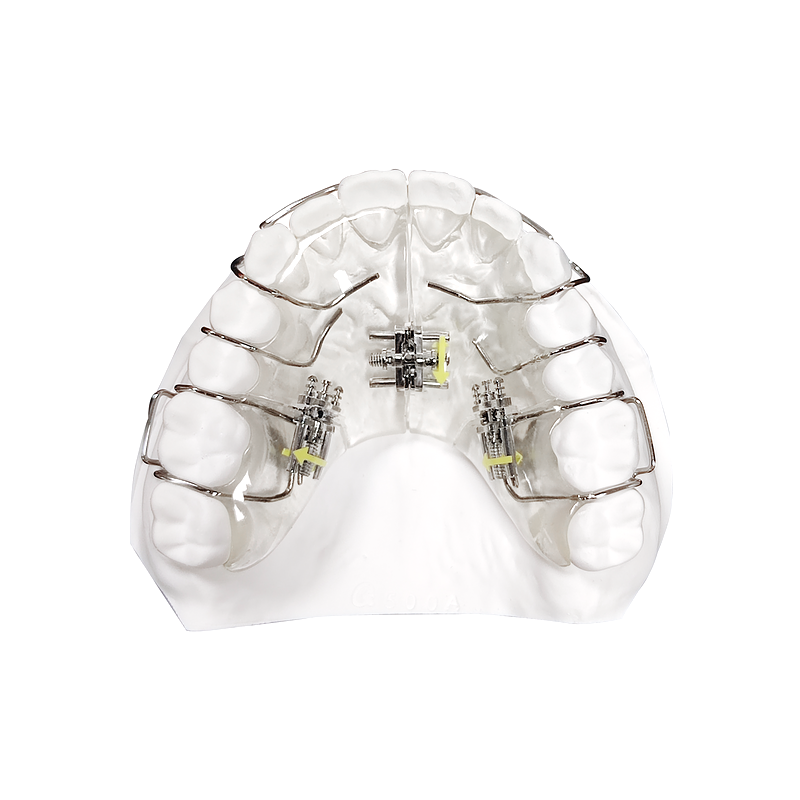 Expansion and Molar Distalization Appliance custom orthodontic appliance