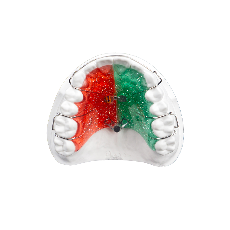 Fan-Type Palatal Expander custom orthodontic appliance