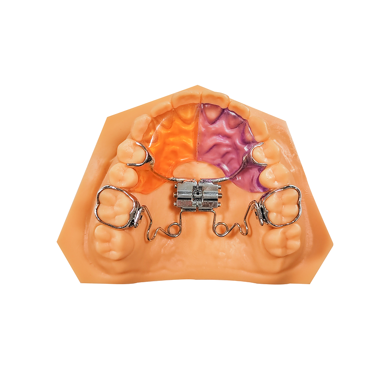 Pendulum Distalizer with Expansion custom orthodontic appliance