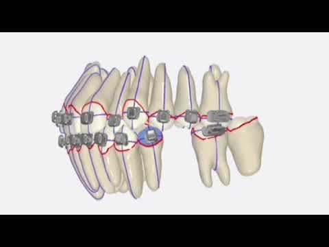 Custom Braces - We made orthodontic treatment easy!