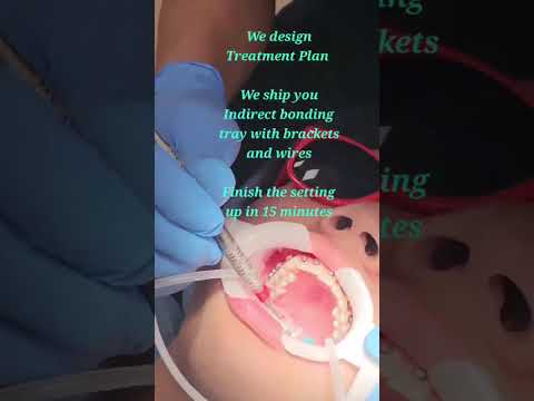 Custom Braces - We made orthodontic treatment easy!
