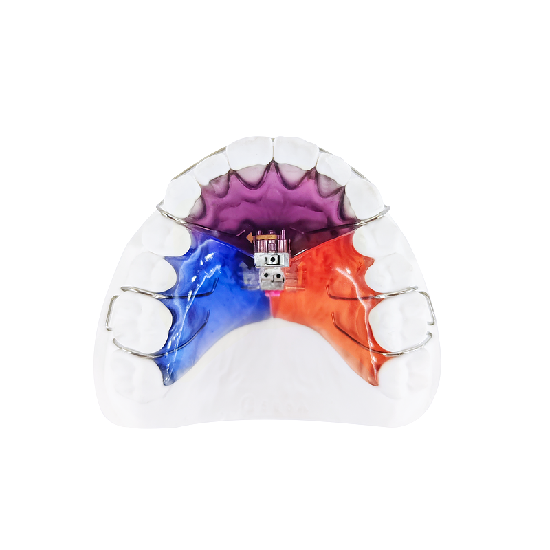 Three-Way Expansion Appliance custom orthodontic appliance