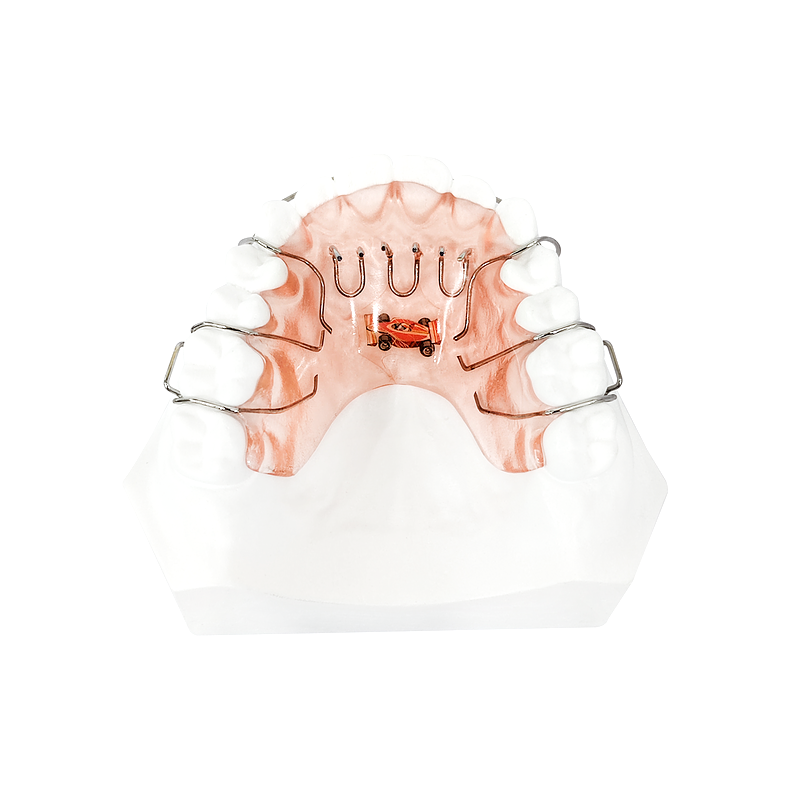 Tongue-Training Orthodontic Appliance custom orthodontic appliance